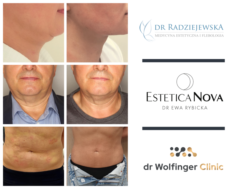 Lifting nieinwazyjny Endolift – co na jego temat mówią lekarze? - Media